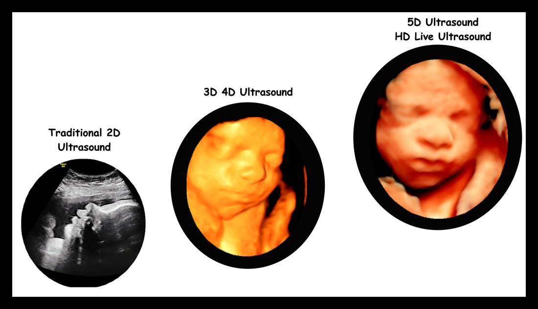 3d vs 4d ultrasounds